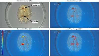 Automated online safety margin (GLIOVIS) for glioma surgery model